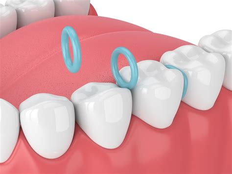 spacers for teeth instructions